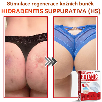 🗽✅GFOUK® Mikrojehličková botanická náplast na odstranění bradavic✔️✔️
