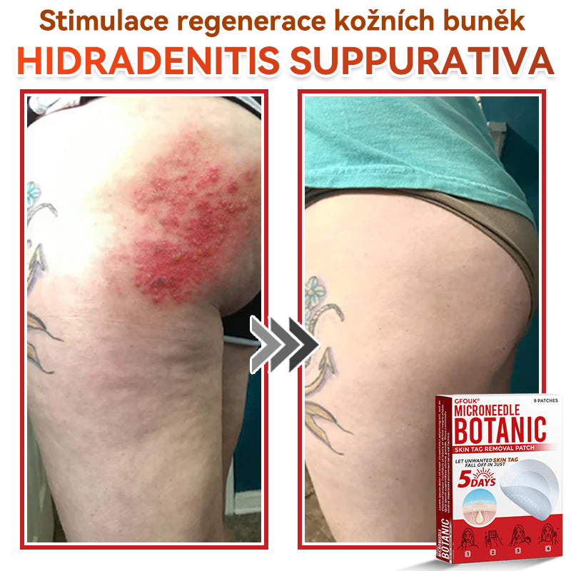 🗽✅GFOUK® Mikrojehličková botanická náplast na odstranění bradavic✔️✔️
