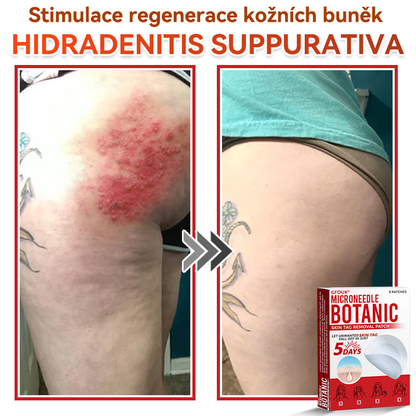 🗽✅GFOUK® Mikrojehličková botanická náplast na odstranění bradavic✔️✔️