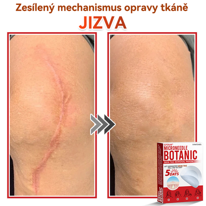 🗽✅GFOUK® Mikrojehličková botanická náplast na odstranění bradavic✔️✔️