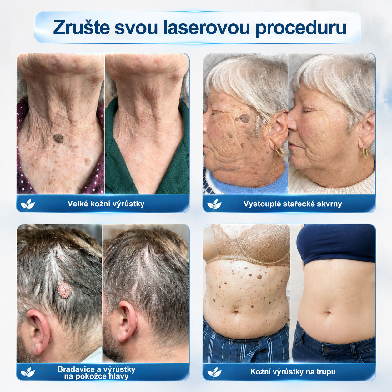 Oficiální značkový obchod |✅️👩‍⚕️𝐏𝐢𝒄𝒅𝒐® 7 dní Odstraňovač kožních skvrn a kožních výrůstků(Bezbolestný rollerball bez jizev)🌳