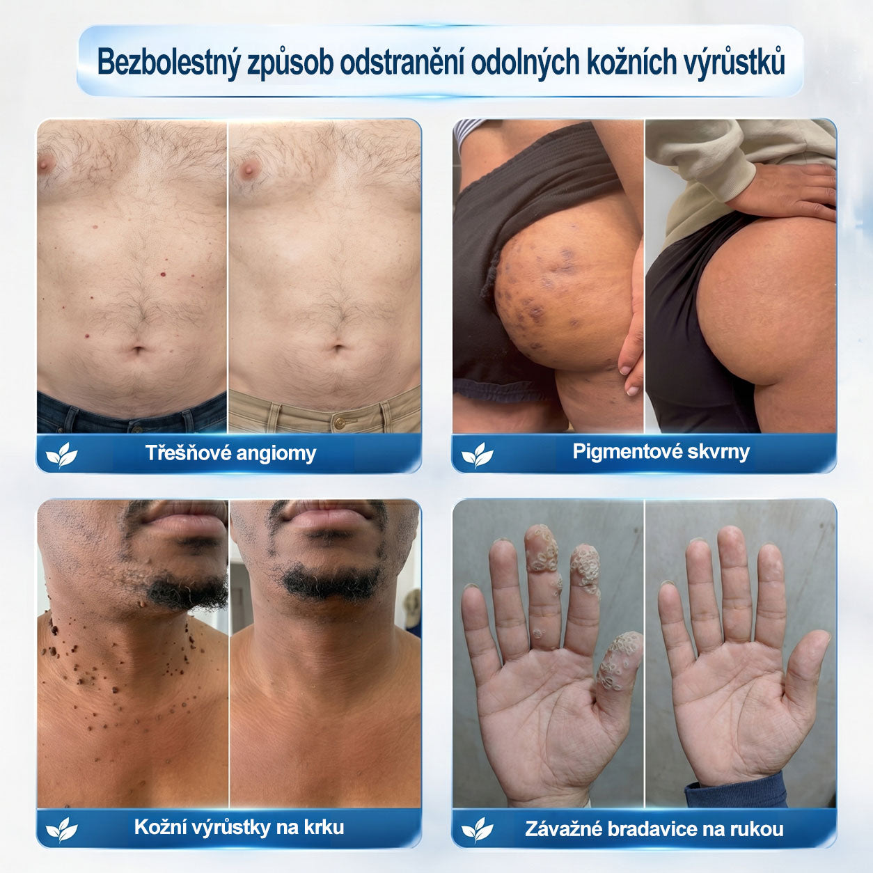 Oficiální značkový obchod |✅️👩‍⚕️𝐏𝐢𝒄𝒅𝒐® 7 dní Odstraňovač kožních skvrn a kožních výrůstků(Bezbolestný rollerball bez jizev)🌳