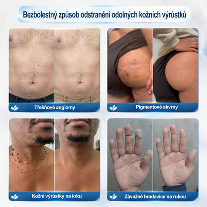Oficiální značkový obchod |✅️👩‍⚕️𝐏𝐢𝒄𝒅𝒐® 7 dní Odstraňovač kožních skvrn a kožních výrůstků(Bezbolestný rollerball bez jizev)🌳