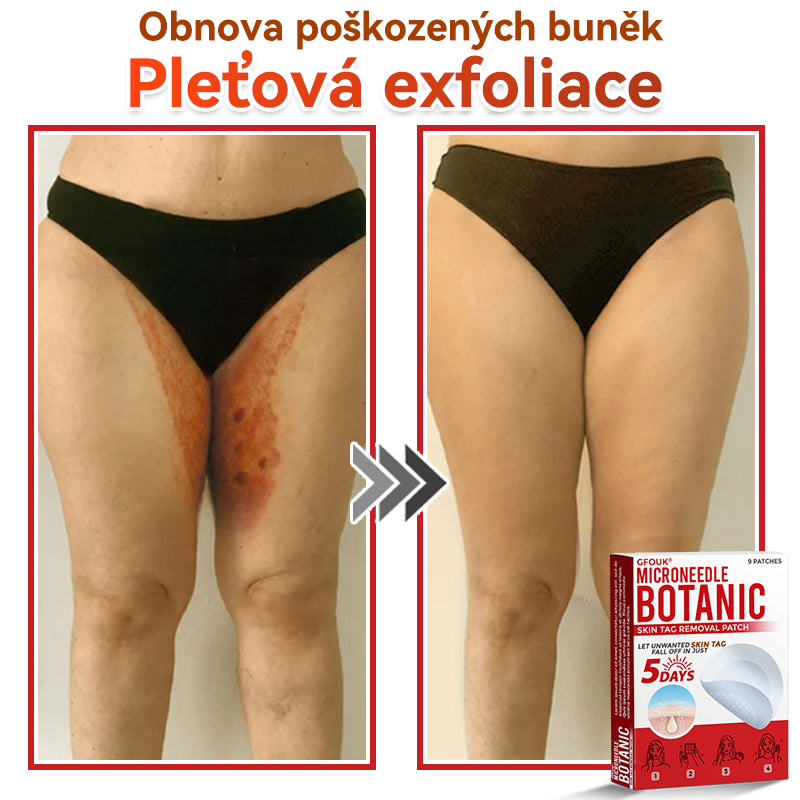 🗽✅GFOUK® Mikrojehličková botanická náplast na odstranění bradavic✔️✔️