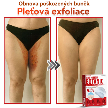 🗽✅GFOUK® Mikrojehličková botanická náplast na odstranění bradavic✔️✔️