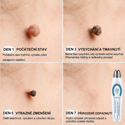 Oficiální značkový obchod |✅️👩‍⚕️𝐏𝐢𝒄𝒅𝒐® 7 dní Odstraňovač kožních skvrn a kožních výrůstků(Bezbolestný rollerball bez jizev)🌳