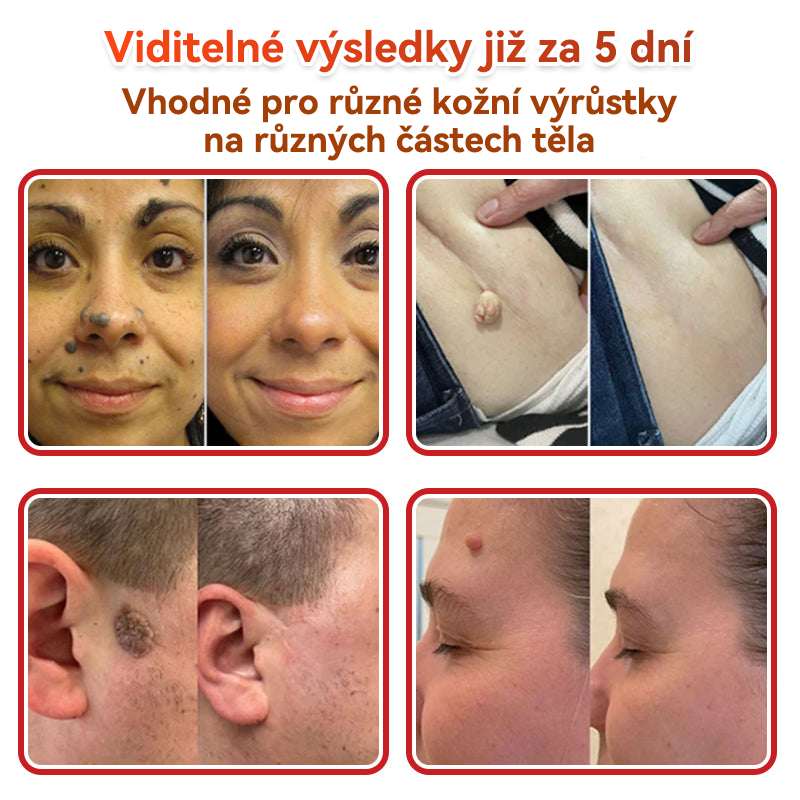 🗽✅GFOUK® Mikrojehličková botanická náplast na odstranění bradavic✔️✔️