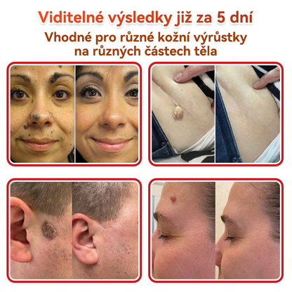 🗽✅GFOUK® Mikrojehličková botanická náplast na odstranění bradavic✔️✔️