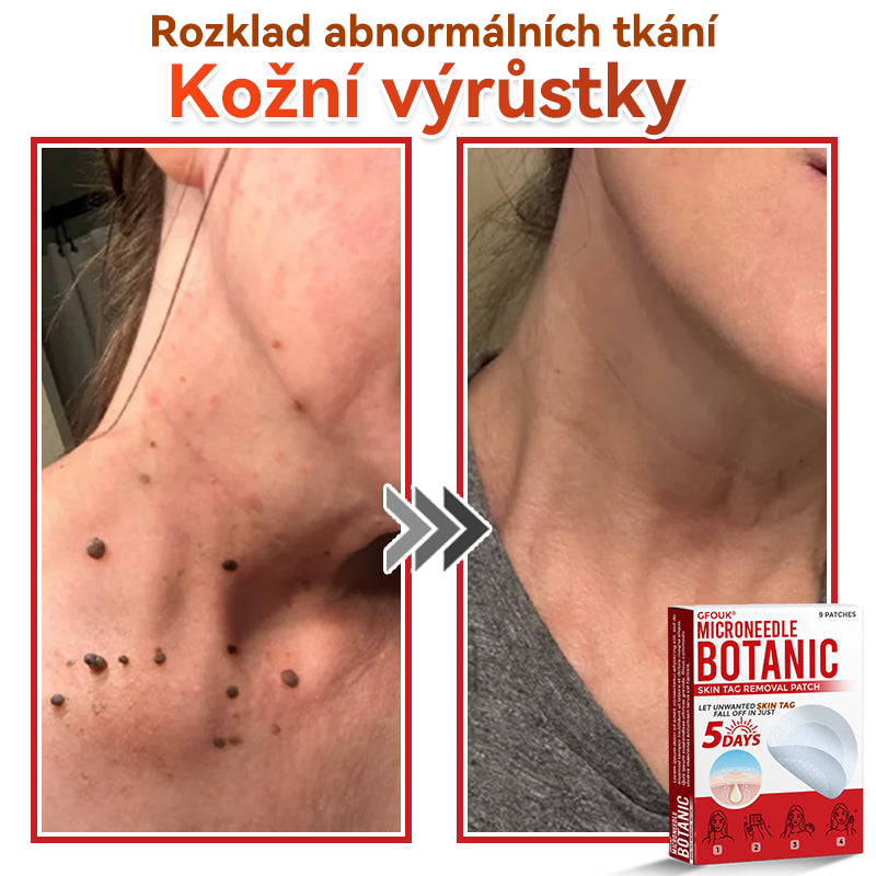 🗽✅GFOUK® Mikrojehličková botanická náplast na odstranění bradavic✔️✔️