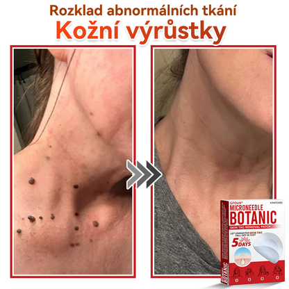🗽✅GFOUK® Mikrojehličková botanická náplast na odstranění bradavic✔️✔️