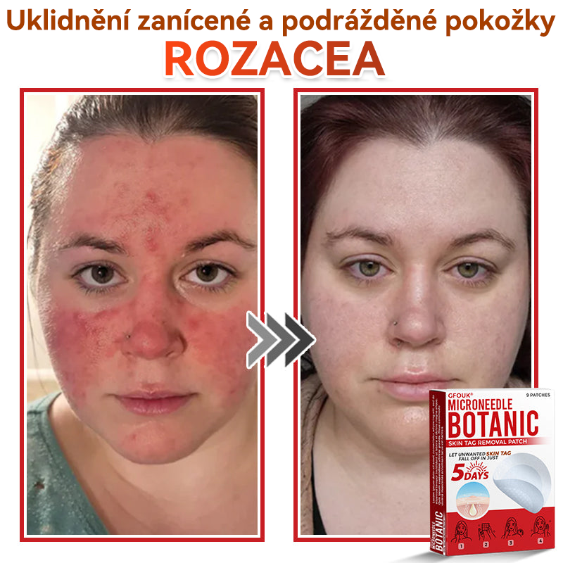 🗽✅GFOUK® Mikrojehličková botanická náplast na odstranění bradavic✔️✔️
