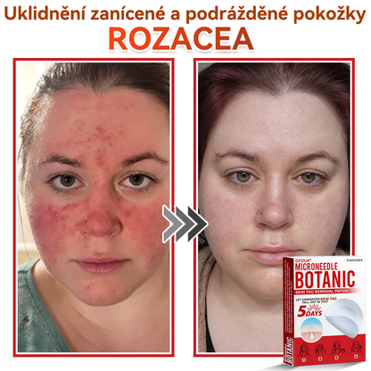 🗽✅GFOUK® Mikrojehličková botanická náplast na odstranění bradavic✔️✔️