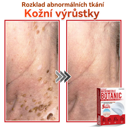 🗽✅GFOUK® Mikrojehličková botanická náplast na odstranění bradavic✔️✔️
