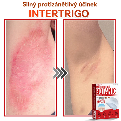 🗽✅GFOUK® Mikrojehličková botanická náplast na odstranění bradavic✔️✔️